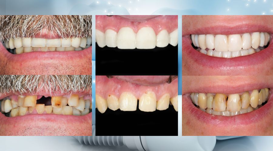 Is it safe to have dental implants in Turkey