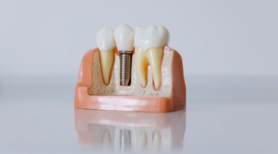 Cost of Dental Implants in Turkey