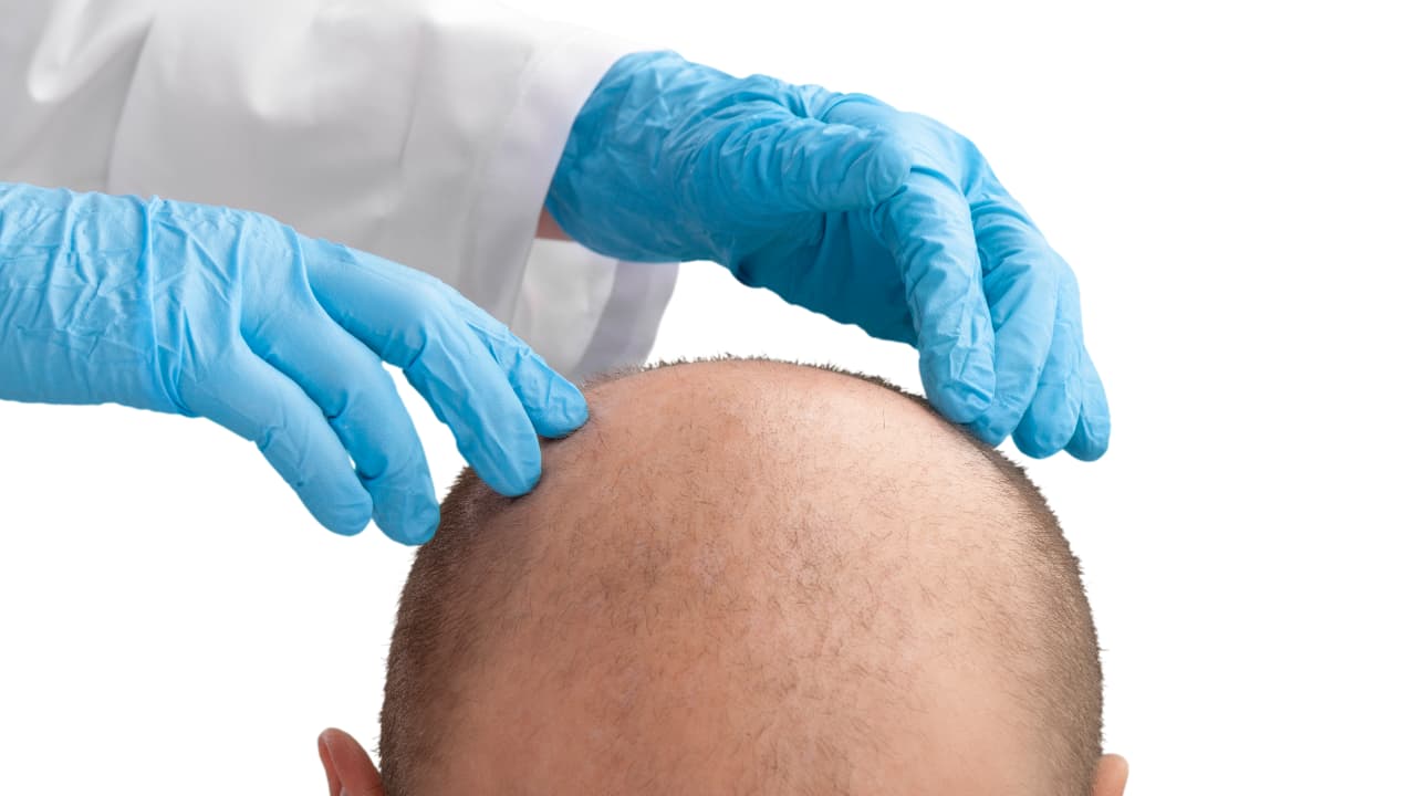 Hair Transplant in Antalya